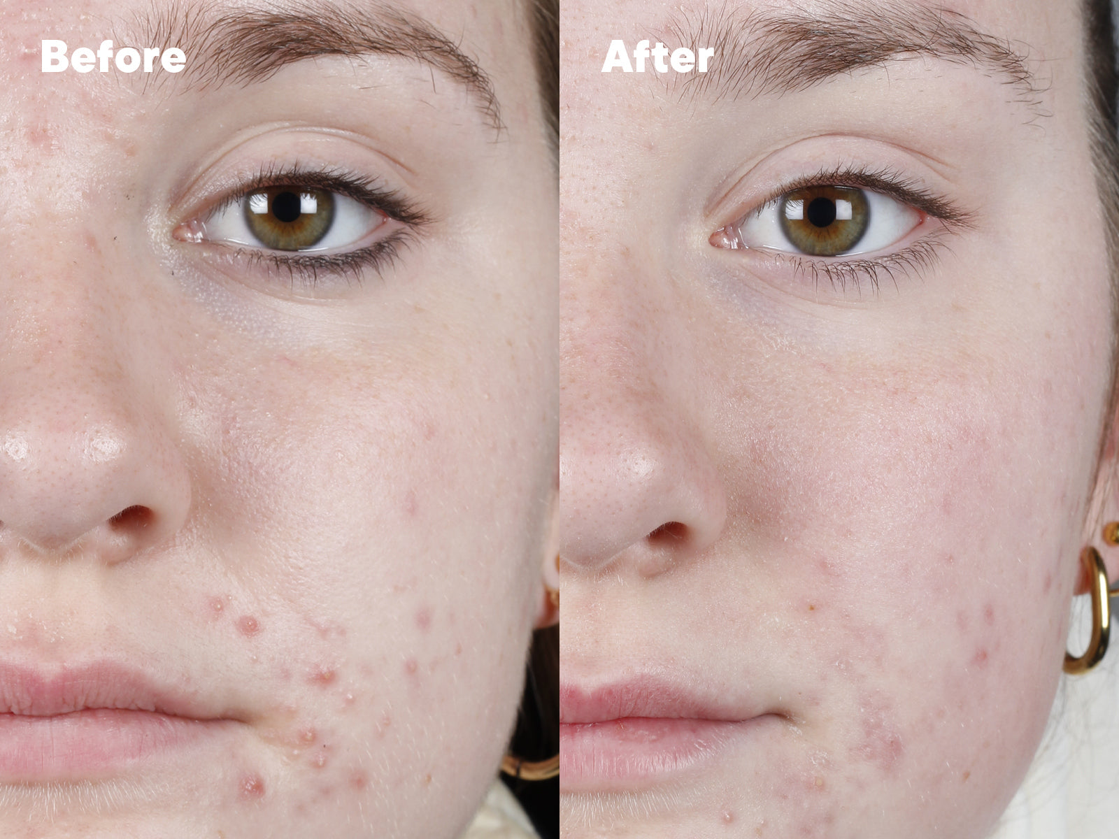 Side-by-side close-up of a person’s lower face showing “Before” with visible acne and redness, and “After” with clearer, smoother skin and reduced blemishes. The person wears gold hoop earrings in both images.