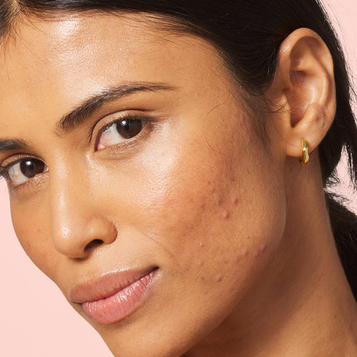Sensitive Skin Symptoms, Causes, And How To Look After It