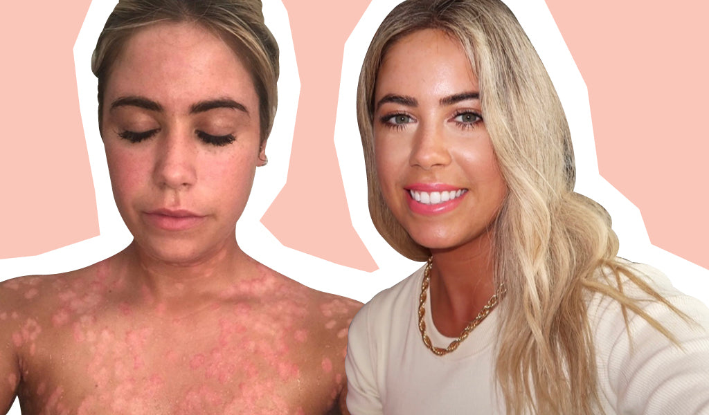 Psoriasis Isn’t Just A Skin Condition